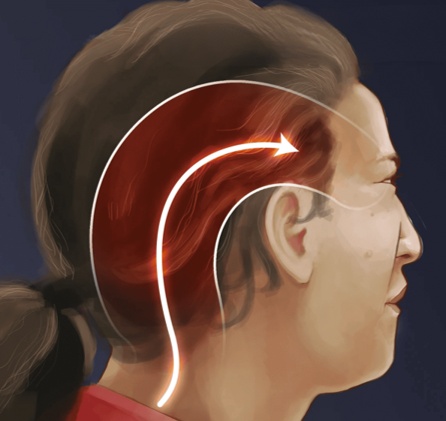 Occipital Neuralgia / Cervicogenic Headache | The pain starts at the back of the head, where it meets the neck, and travels up and over the head towards the eye